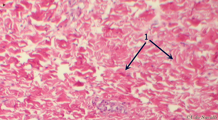 dense irregular CT