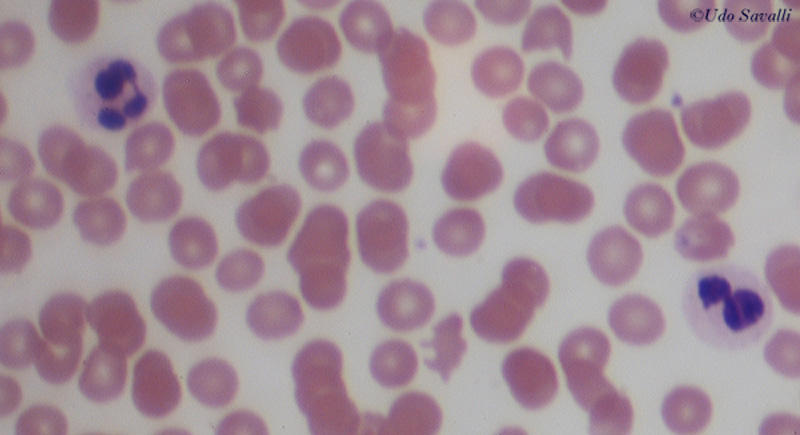 Blood Smear