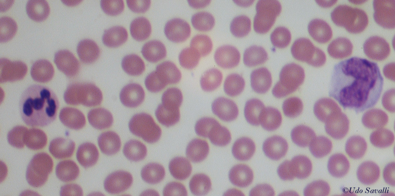 Blood Smear